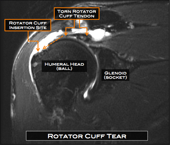 Rotator Cuff Tear On Mri